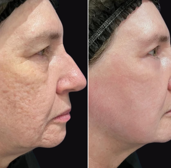 Skin rejuvenation with Phenol-Croton Oil Peel